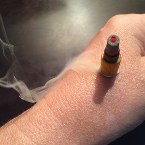 Example of moxibustion on a patient’s left hand.