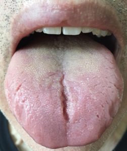 Tongue of split middle in What Is