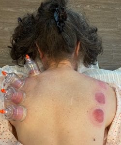 a woman has cups on her left upper back, and cupping marks on her right side